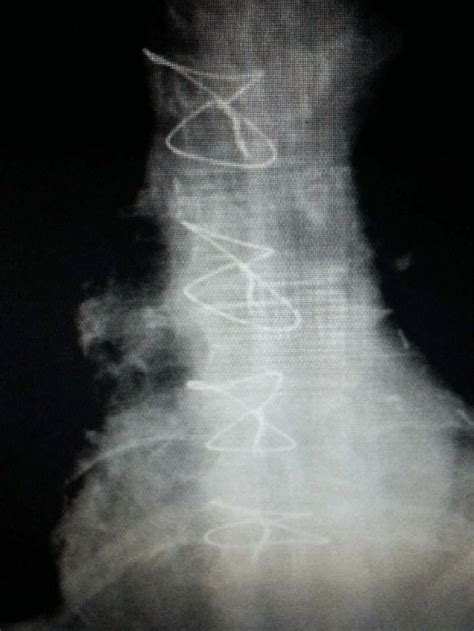 Figure-of-eight closure of median sternotomy. | Download Scientific Diagram