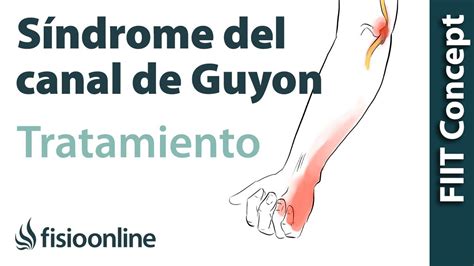 Tendinitis Cubital Anterior Y S Canal De Guyon Visi N Desde La