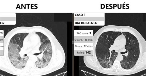 Cambio De Paradigma En La Terapia Intensiva Por Covid Un Innovador