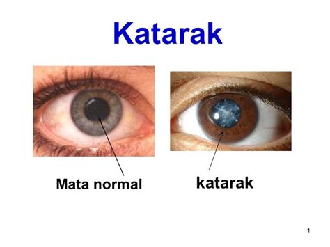 Katarak