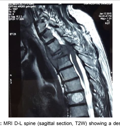 Figure 1 From Solitary Plasmacytoma Of The Axial Spine And Dorsal Spine Treatment Dilemmas