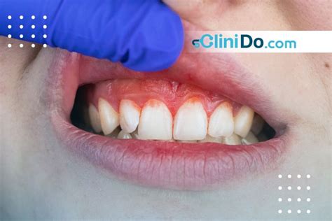 Gingivitis: Symptoms, Causes& Preventions - CliniDo Blog