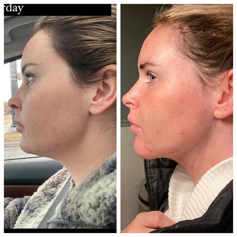 Chin Lipo Hours Later Tumescent And Laser Super Happy So Far And