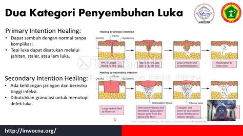 Proses Penyembuhan Luka Newstempo