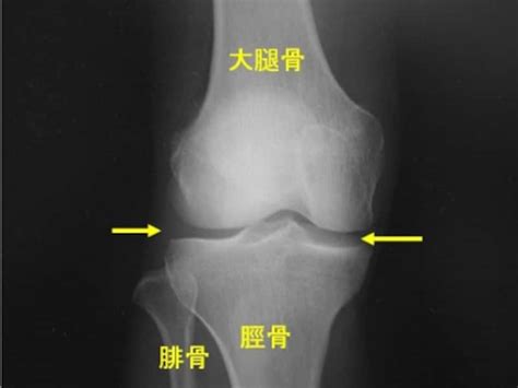 半月板損傷の診断・原因・治療 骨・筋肉・関節の病気 All About