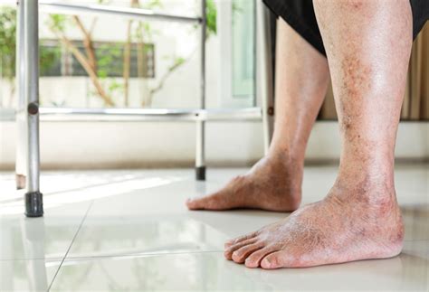 4 Risk Signs Of Peripheral Arterial Disease Everyone Should Look Out