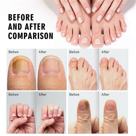 Nail Treatment Paronychia Remove Cream Fungal Onychomycosis Nail Repair