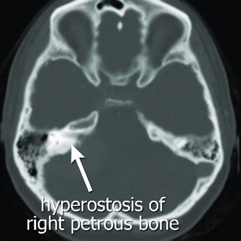 Postoperative Mri Of The Brain Of Our Patient Showing Complete