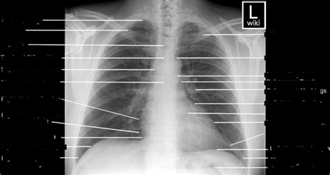 chest radiographic anatomy diagram quizlet