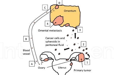 Figure 1 from Ovarian Cancer Metastasis: A Unique Mechanism of ...