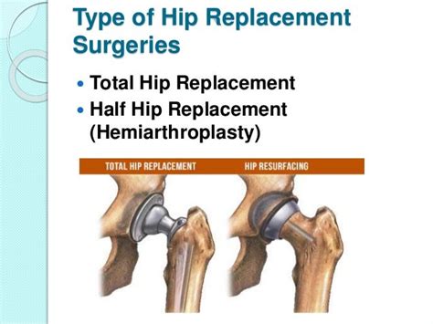 Hip Replacement Surgery In Delhi Dr L Tomar