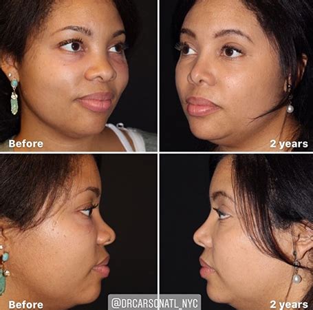 Best Rhinoplasty Atlanta GA Radiance Surgery And Aesthetic Medicine