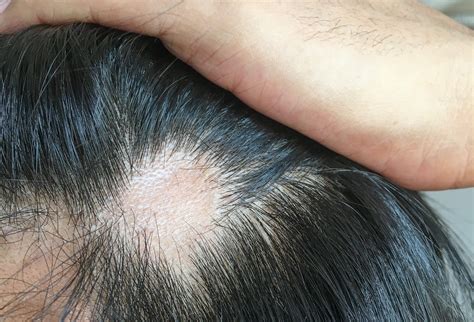 Baldness cure a step closer as scientists grow hair in a lab - I Know