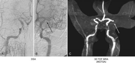 Neurovascular Imaging | Neupsy Key