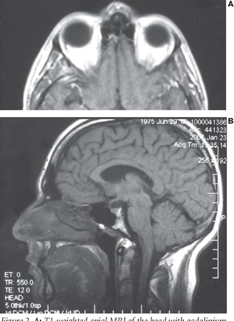 Figure 1 From Adult Nasal Dermoid Sinus Cyst Semantic Scholar