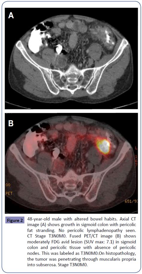 Pet Scan Colon Cancer