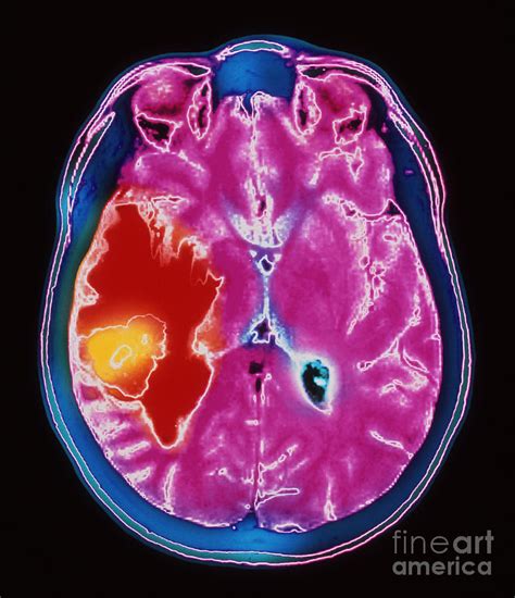 Brain Tumour Photograph By Simon Fraser Royal Victoria Infirmary