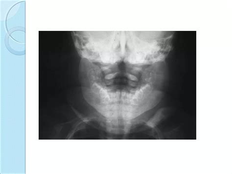 Osteochondritis dessicans ,caisson disease, caffey’s disease | PPT
