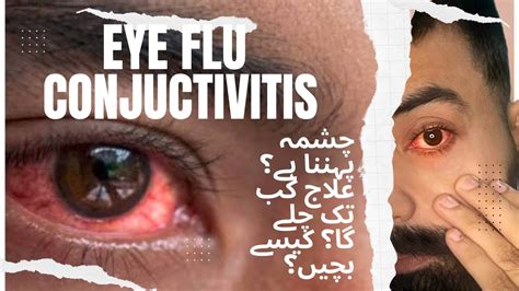 Protect Your Eyes Unveiling The Secrets Of Eye Flu Conjunctivitis