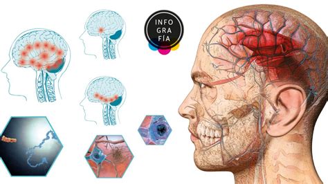 Identifican 42 Genes Asociados Al Riesgo De Tener La Enfermedad De