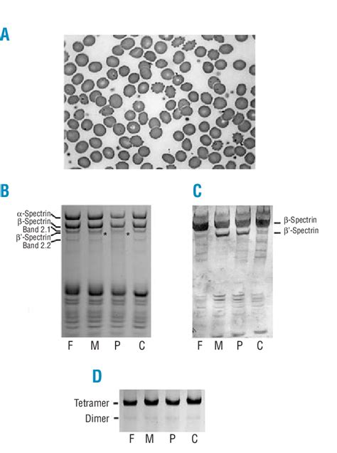 (A) Patient's blood smear shows spherocytes and acanthocytes . (B ...