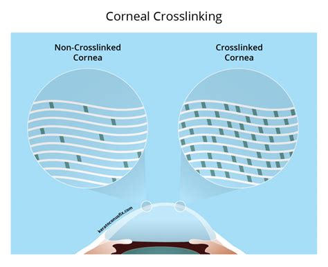 Surgical Treatments For Keratoconus Custom Sclerals