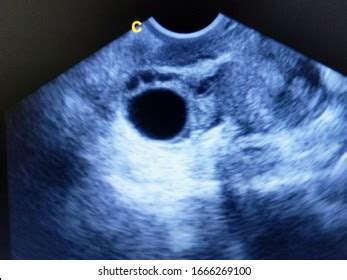 Normal Follicle By Ultrasound Scan Stock Photo 1666269100 | Shutterstock