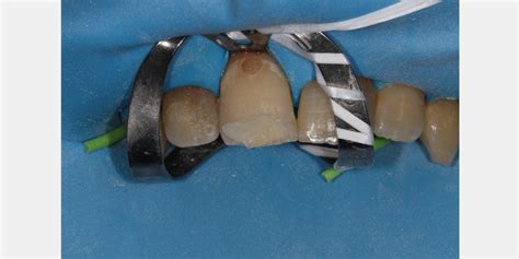 Rubber Dam Isolation Technique Dental Guide For Clamp 56 Off