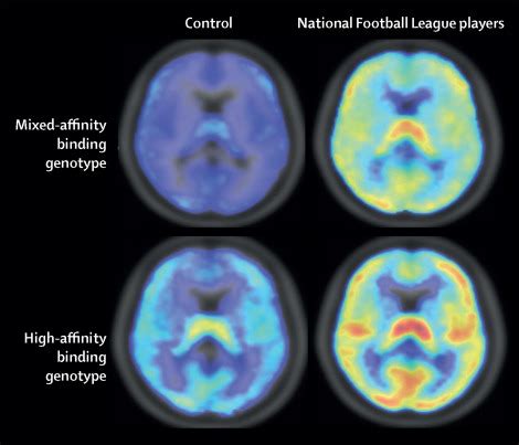 Pet Imaging Of Neuroinflammation In Neurological Disorders The Lancet