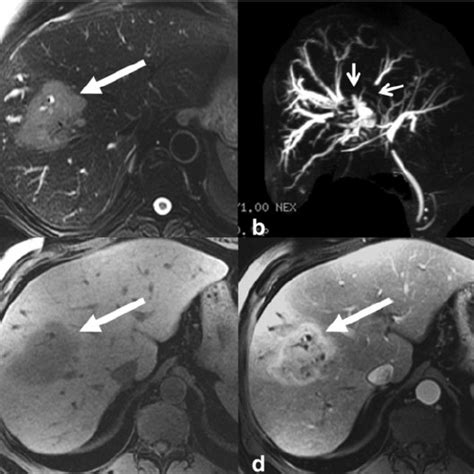 Examples Of Intrahepatic Cholangiocarcinoma Icca On Ultrasound In Two