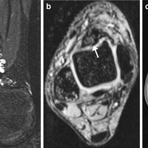 MRI example of patellar chondromalacia in a 14-year-old girl with ...