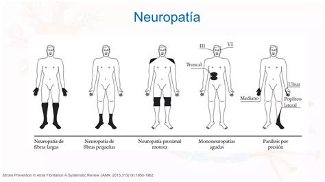 Neuropatia Diabetica Ppt