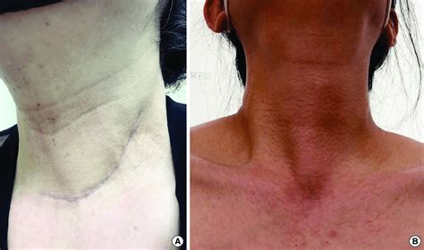 Comparison Of Surgical Wounds A Scar From Open Modified Radical Neck