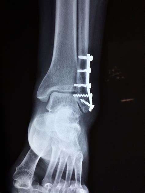 ankle-fracture-foot-2253057 – Andalab Medical Laboratories