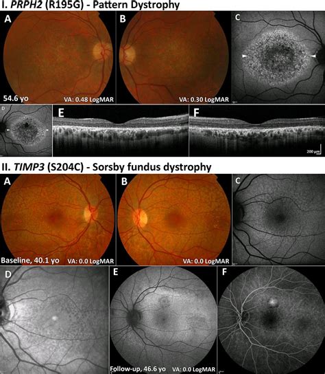 Macular Dystrophies Clinical And Imaging Features Molecular Genetics