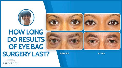 How Long Does Eye Bag Removal Surgery Lower Blepharoplasty Last Youtube