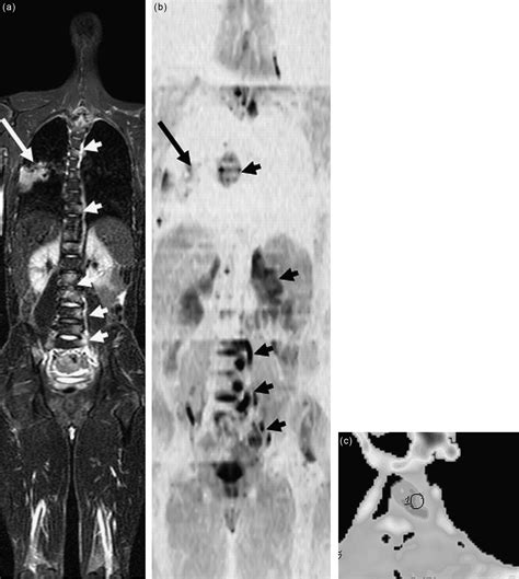 Diffusion Weighted Whole Body Mr Screening European Journal Of Radiology