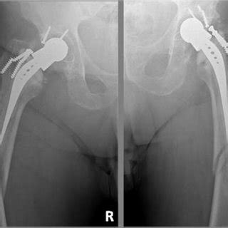 Preoperative Anteroposterior Radiograph Of The Pelvis Showing Bilateral