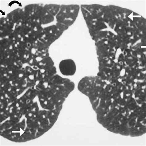 Thirty Three Year Old Man With Silicosis A Chest Radiograph Shows