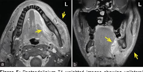 Figure 1 From Chronic Diffuse Sclerosing Osteomyelitis Of The Mandible