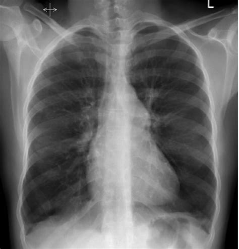 Lung Infection Flashcards Quizlet