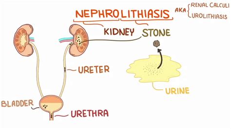 Schematic Diagram Of Pathophysiology Of Nephrolithiasis Neph