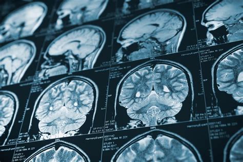 What Is An Anoxic Brain Injury Harris Lowry Manton LLP