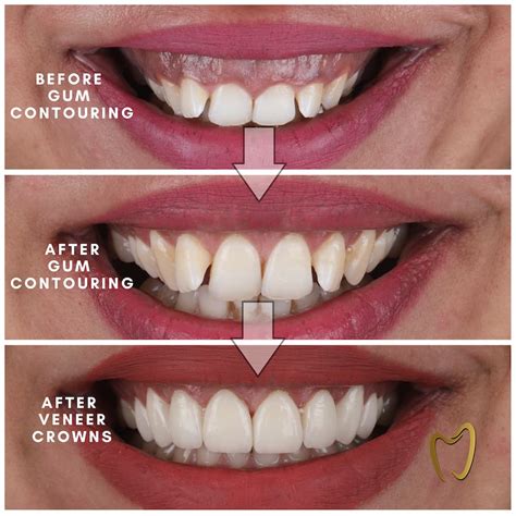 What Is Gum Contouring Maltepe Dental Clinic