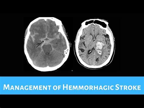 Management of Hemorrhagic Stroke | Stroke Recovery Tips