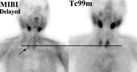 Radionuclide Imaging Of The Parathyroid Glands Patterns Pearls And