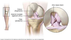 Cuánto tiempo tarda en curarse una rotura de ligamentos 2025