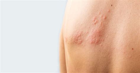 Shingles Symptoms No Rash Treatment - Infoupdate.org