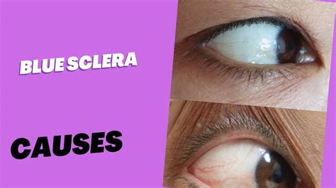 Blue Sclera Causes Youtube