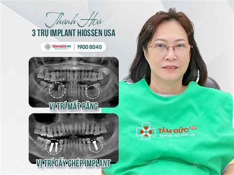 Tr Implant Ph P C U I M G Tr Implant T T T I Nha Khoa T M C